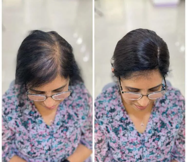 Custom-fitted breathable mesh integration hair loss system for maximum coverage.